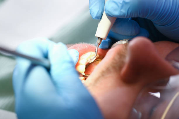 Best Emergency Dentist for Knocked-Out Tooth in Lahoma City, OK